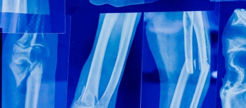 When Home Becomes the Workplace: Employee Compensated for Injury During Coffee Break